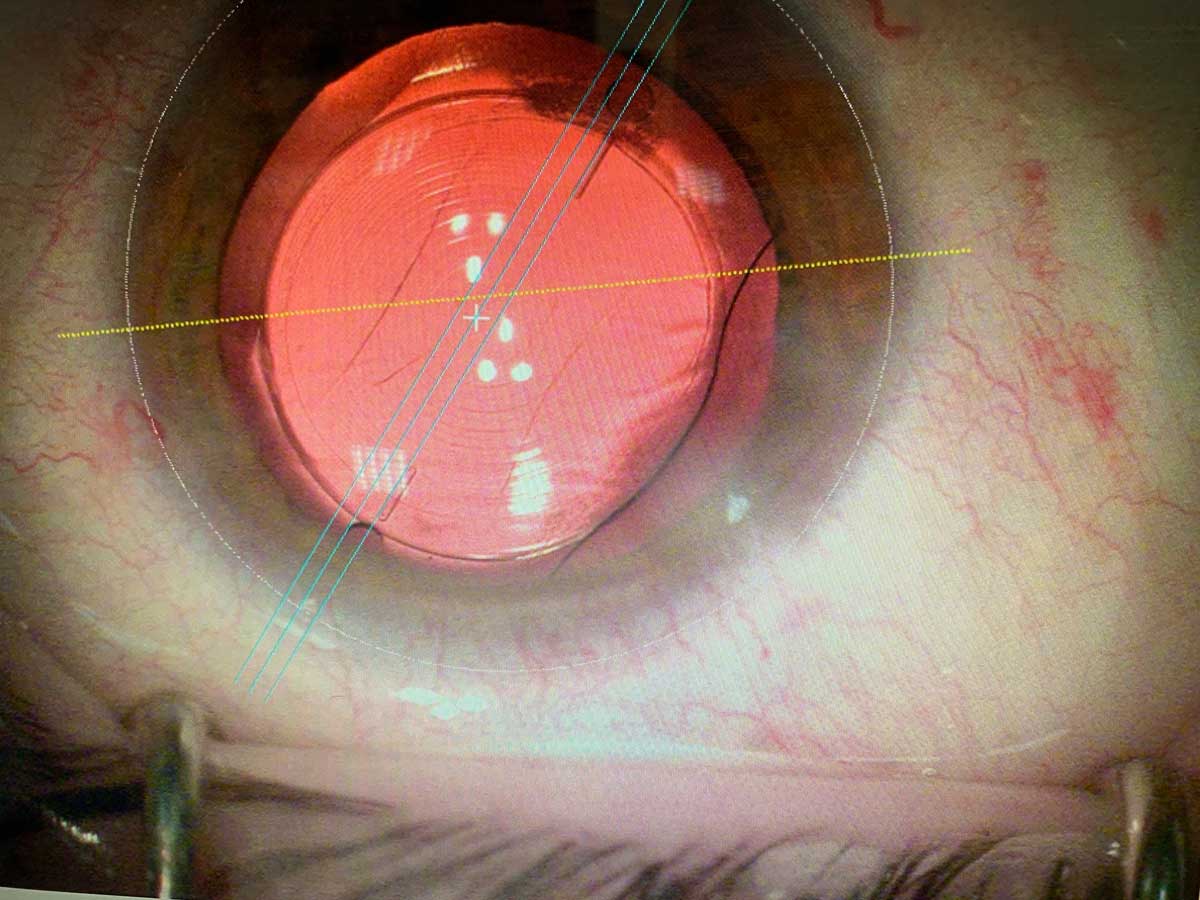 MISE EN PLACE D’UN IMPLANT INTRAOCULAIRE AVEC LE LASER FEMTOSECONDE