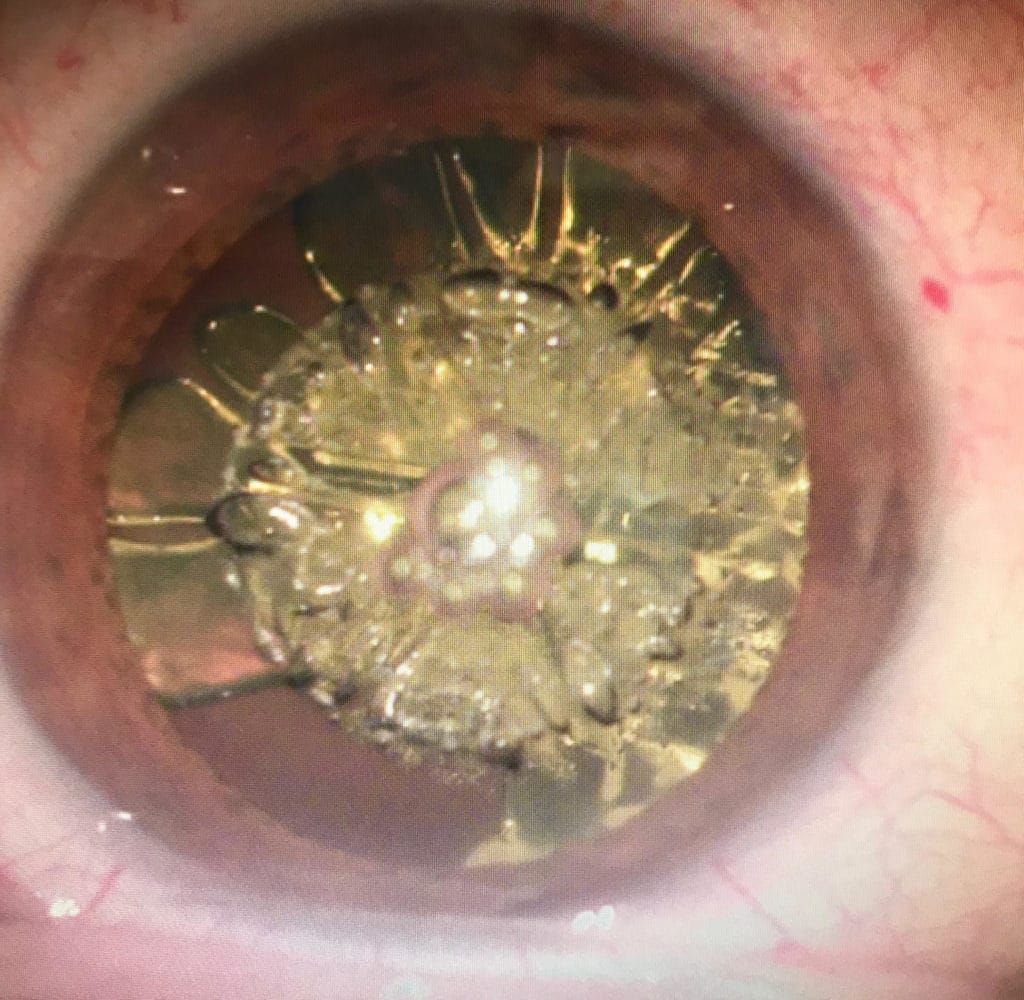 cristallin cataracté par phakofragmentation au laser femto seconde